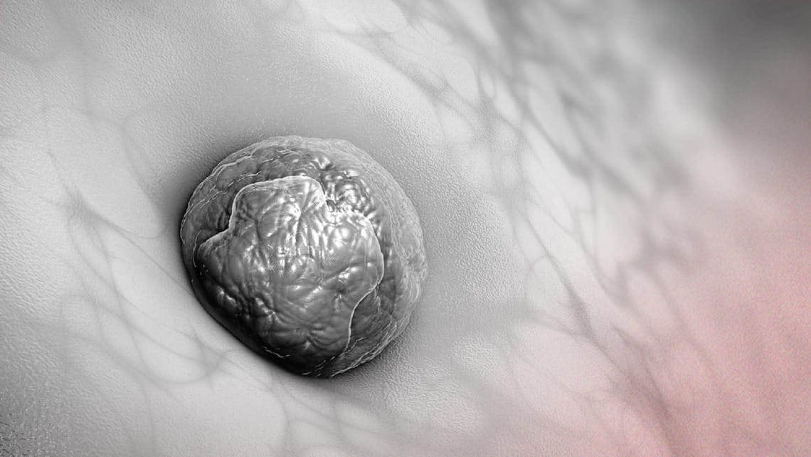 Embryo transfer illustration